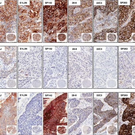 Microphotographs Of Representative Examples Of Ihc Pd L Expression By