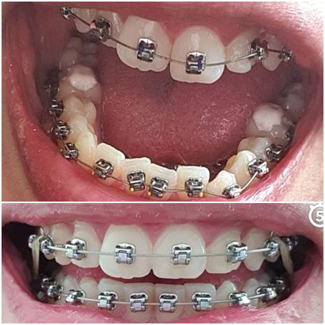 Overbite Braces Rubber Bands