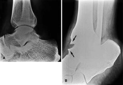 Figure 4 From Pathoanatomy Of Anterior Ankle Impingement In Dancers