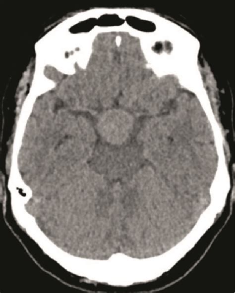 Initial Contrast Enhanced Brain Ct Ac Images Show A Voluminous