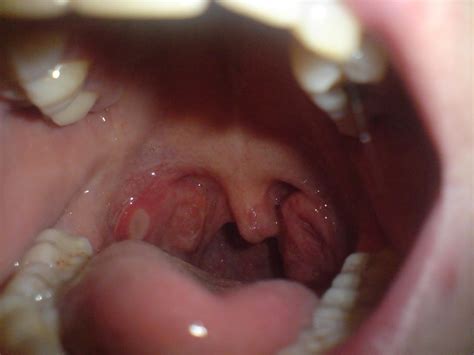 Mouth Ulcers Types Causes Symptoms And Treatment