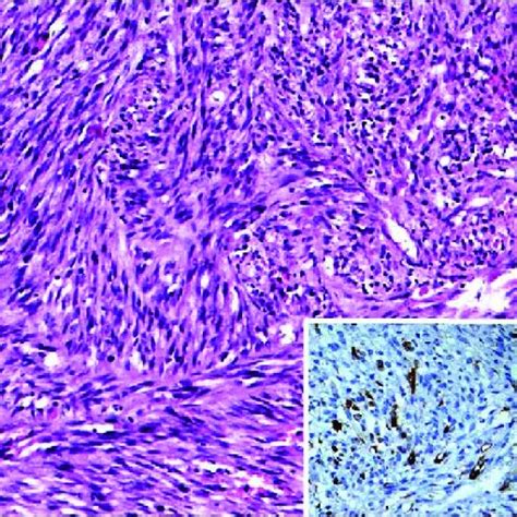 Cellular Tumor Composed Of Spindle Cells Arranged In Fascicles H And