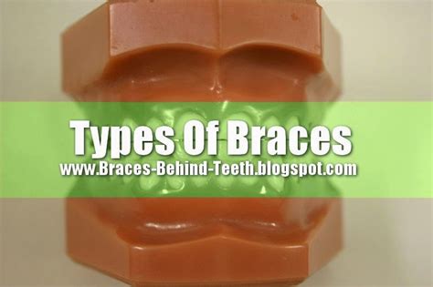 Types Of Braces