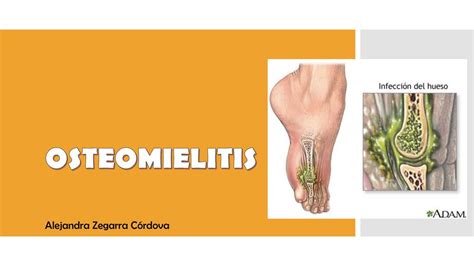 Osteomielitis Aguda Y CrÓnica Diapositivas Medicina Udocz