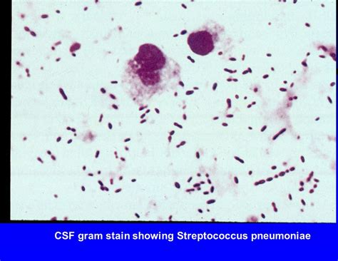 Streptococcus Pneumoniae Gram Stain Csf