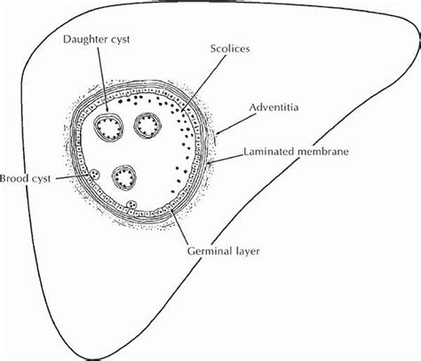 Hydatid Cysts Of The Liver Diagnosis Complications And Treatment Intechopen