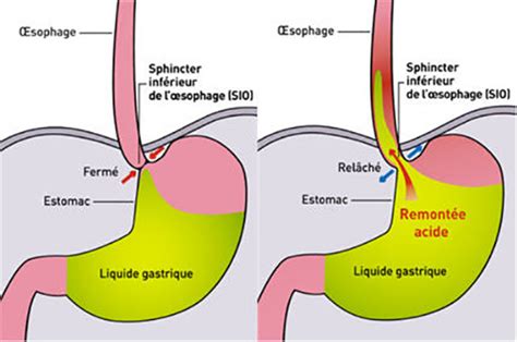 25 Remèdes Naturels Pour Traiter Le Reflux Gastro Oesophagien Santé