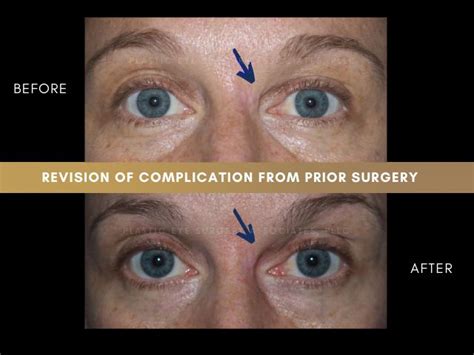 Lower Blepharoplasty Gone Wrong