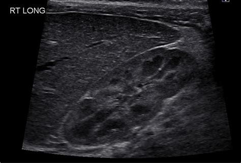 Longitudinal ultrasound image of the liver and right kidney in a normal ...