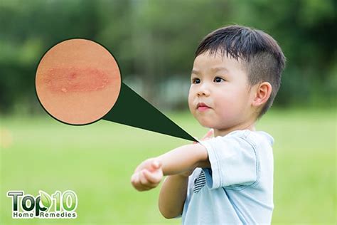 Ringworm In Children