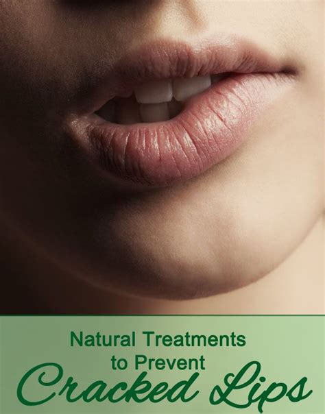 Natural Treatments To Prevent Cracked Lips Natural Treatments Health