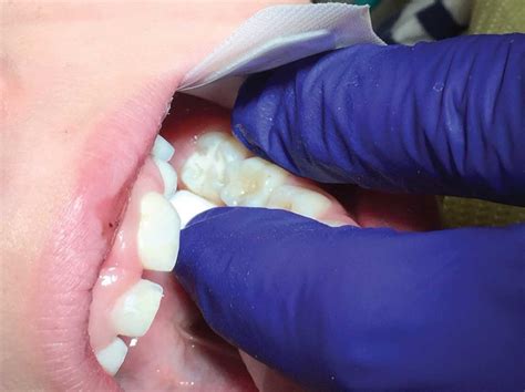 Glass Ionomer Cement Sealants By Dr Jeanette Maclean Dentaltown