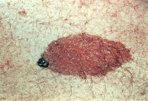 Mole Or Melanoma Test Yourself With These Suspicious Lesions