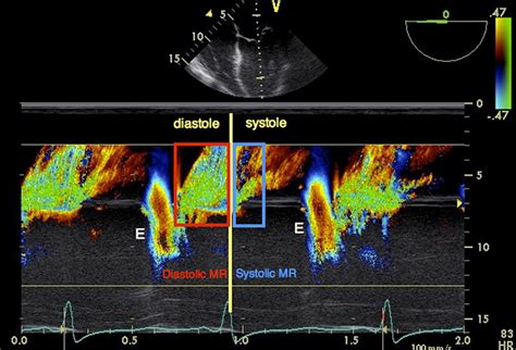 Pulmonary Venous Diastolic Flow Reversal In Severe Aortic Regurgitation