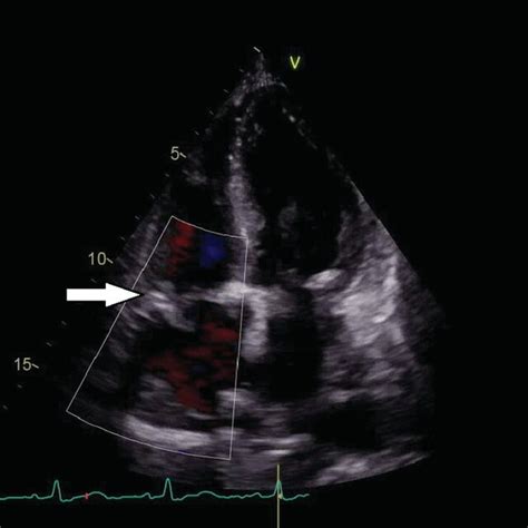 Doppler Echocardiogram Of The Preoperative Tricuspid Valve Showing Download Scientific Diagram