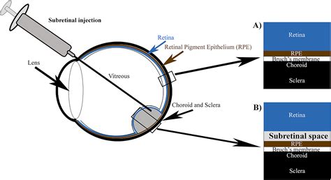 Subretinal Surgery Functional And Histological Consequences Of Entry