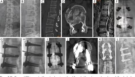 Figure 3 From Balloon Kyphoplasty Combined With Posterior Pedicle Screw Fixation For The