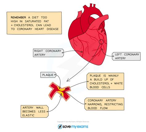 Coronary Heart Disease Skills Sl Ib Biology Revision Notes 2025