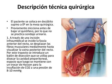 Laparoscopica Hernia Inguinal Ppt