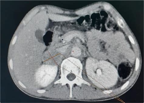 Abdominal Ct Demonstrating A Right Adrenal Mass Hypodense