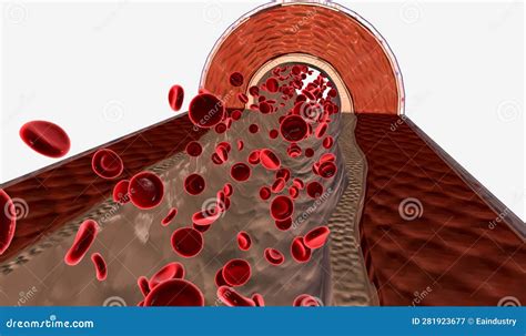 pulmonary hypertension    pressure   blood vessels