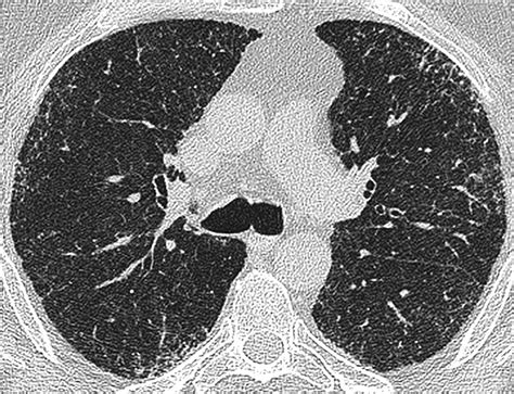 Connective Tissue Disease Related Fibrotic Lung Disease High