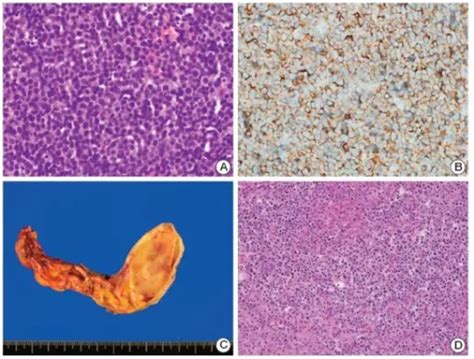 What is Diffuse Large B-Cell Lymphoma? – Pathosomes