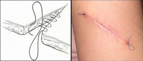 Tipos De Suturas Que Estudantes De Medicina Devem Conhecer