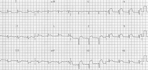 Anterior Myocardial Infarction • Litfl • Ecg Library Diagnosis