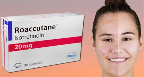 Roaccutane Neye Yarar Yan Etkileri Kombin Kad N