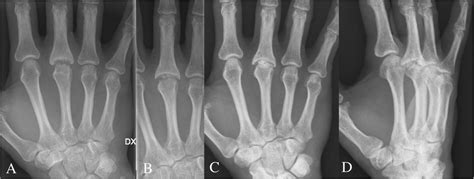 The Same Patient As In Fig 4 Fight Bite Injury Resulting In Septic