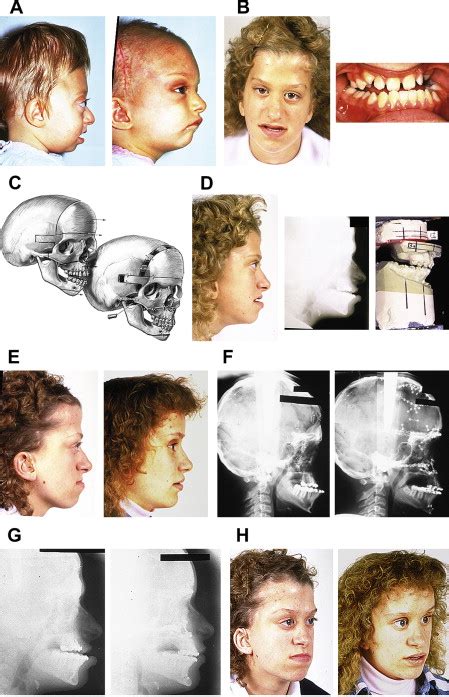 Craniofacial Dysostosis Syndromes Evaluation And Staged Reconstructive