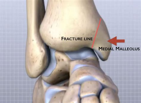 Medial Malleolus