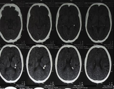 Ct Of The Brain Showing Calcified Density Along Right Lateral Ventricle Download Scientific