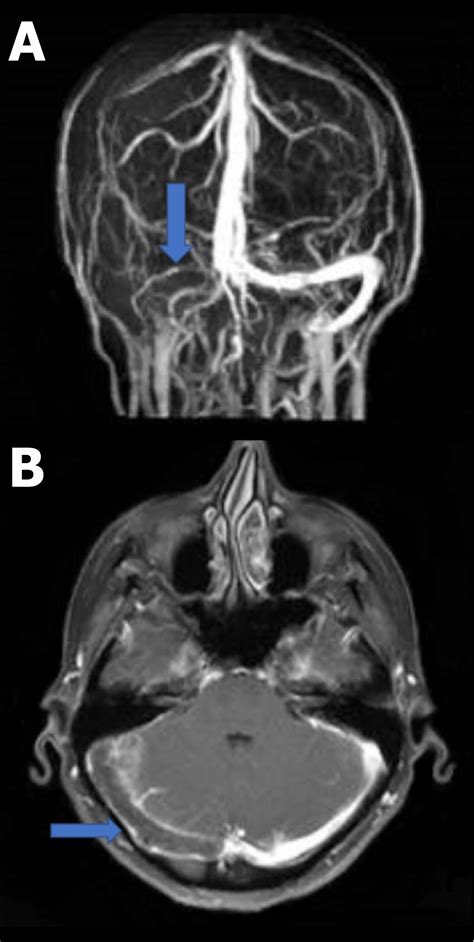 Cerebral Venous Thrombosis Causes Risk Factors Symptoms Diagnosis