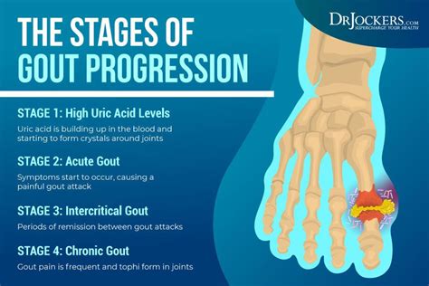 Causes Of High Uric Acid Valerie Has Lewis