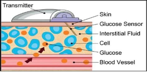 Fifteen Minute Consultation Practical Use Of Continuous Glucose