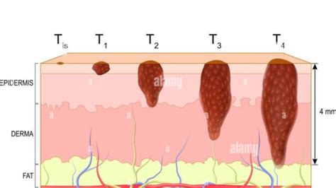 Melanoma Diagnosis Early Stage - Dr Symptoms Diseases Symptoms ...