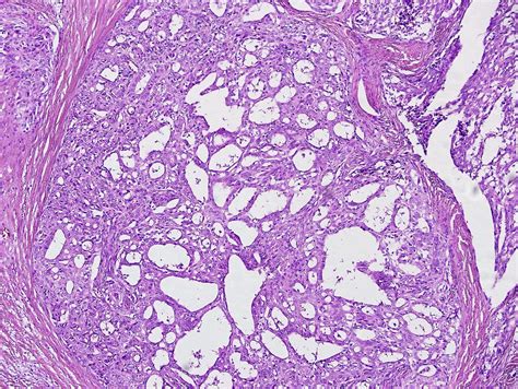 Pathology Outlines Cribriform Morular Thyroid Carcinoma