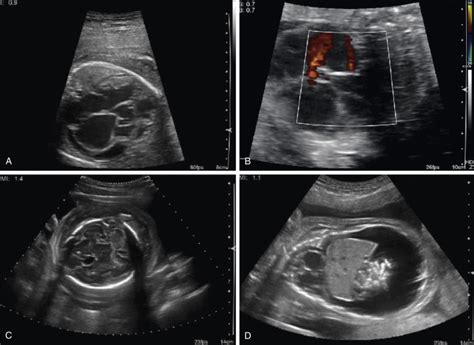 Sonographic Evaluation Of The Fetal Heart Radiology Key