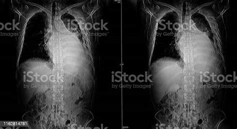 Computer Tomography Angiography Cta Of Whole Body Scan With 3d Reconstruction Ct Angiography For