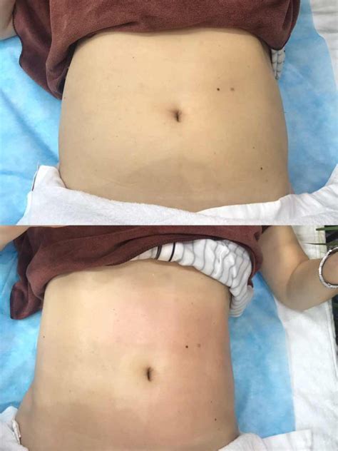 Velashape Before And After Vivalaser For You For All For Beauty