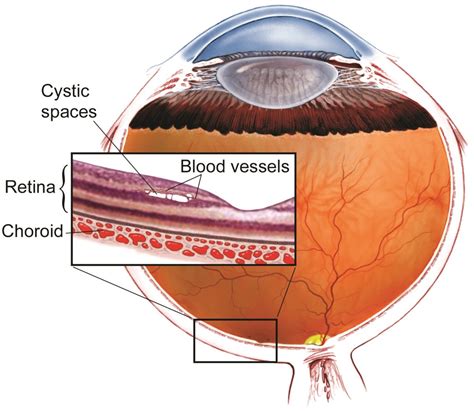 Idiopathic Juxtafoveal Telangiectasis Retina Specialists Of North