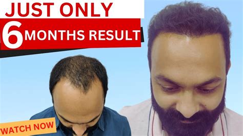 Hair Transplant In Gwalior Best Hair Transplant Results Gwalior Youtube