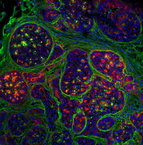 Breast Cancer Tumour Basement Image Eurekalert Science News Releases