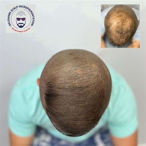 The Top 5 Scalp Micropigmentation Benefits Transforming Lives With