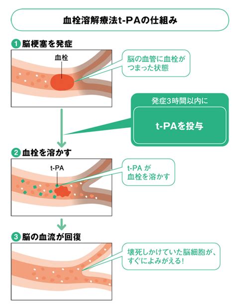 吉原 清児著 『医師がすすめる「最高の名医」治る病院』 脳梗塞･脳出血t Pa血栓溶解療法（） 現代ビジネス 講談社（25）