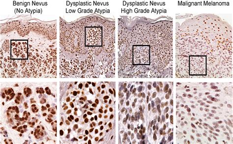 Loss Of 5 Hydroxymethylcytosine Correlates With Increasing Morphologic