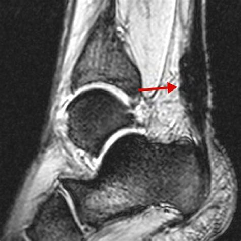 Sagittal T2 Weighted MR Image Shows Markedly Thickened Achilles Tendon