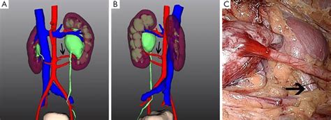 Ureteropelvic Junction Obstruction With Left Renal Crossing Artery Download Scientific Diagram